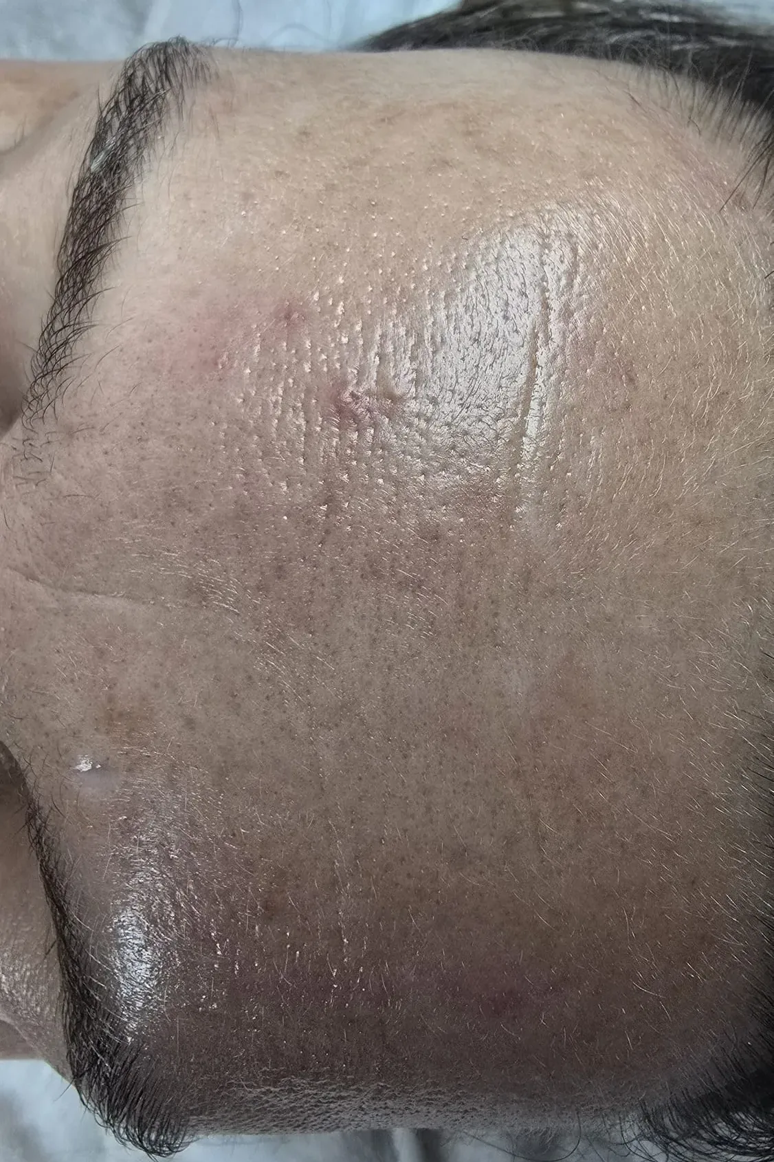 Nachher Gesichtsbehandlung Larisa Cosmetic Winterthur