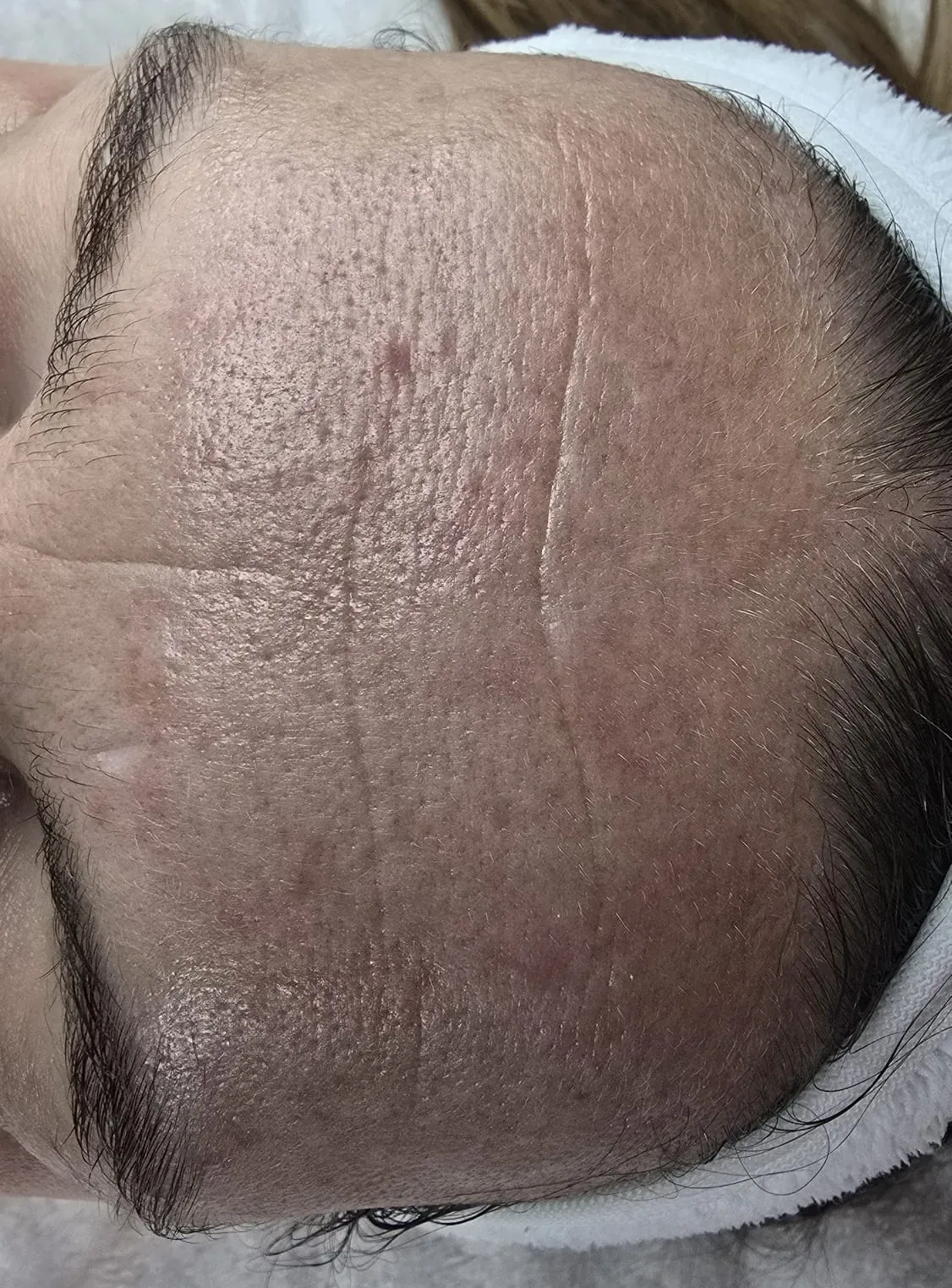 Vorher Gesichtsbehandlung Larisa Cosmetic Winterthur