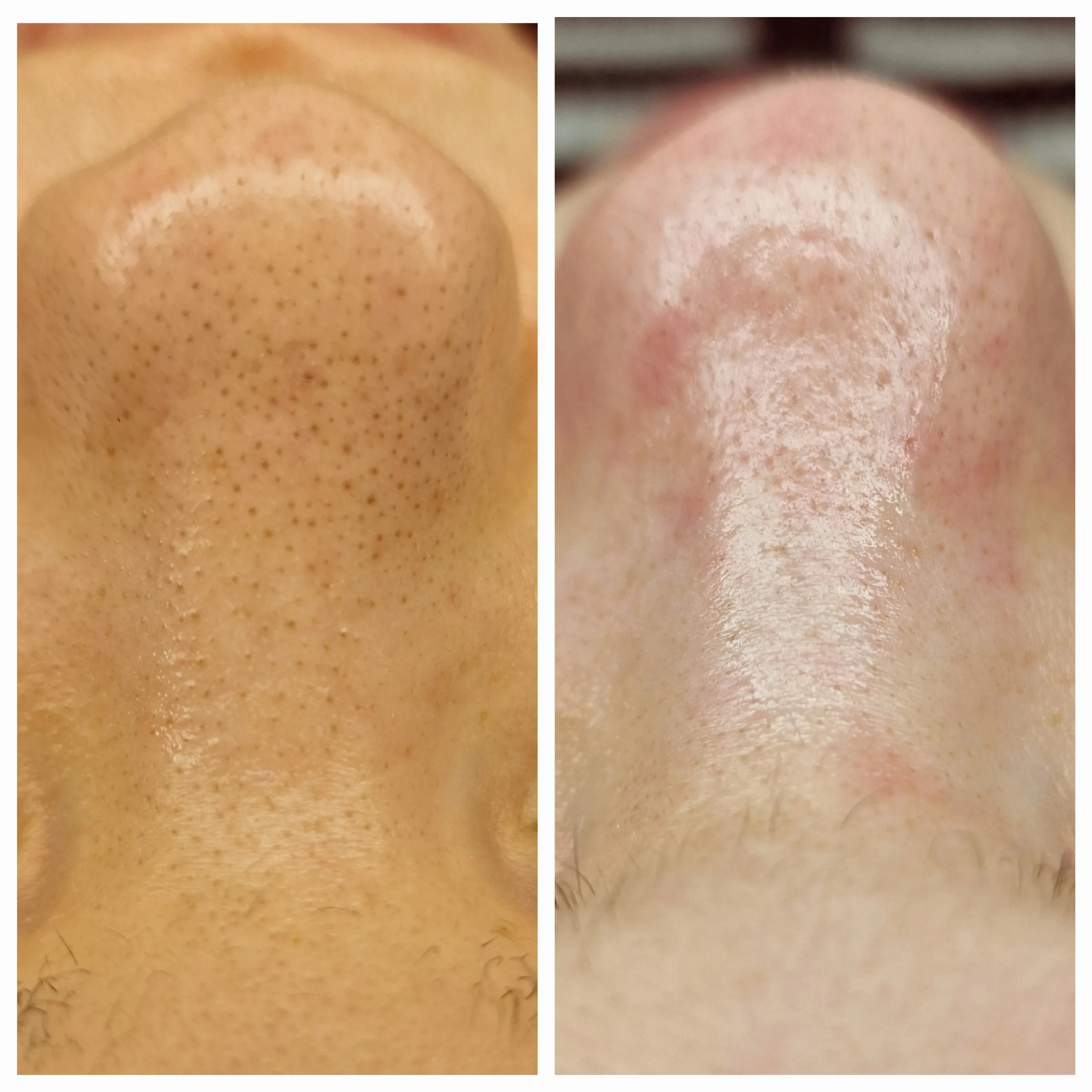 Tiefenreinigung Gesicht Resultat Larisa Cosmetic