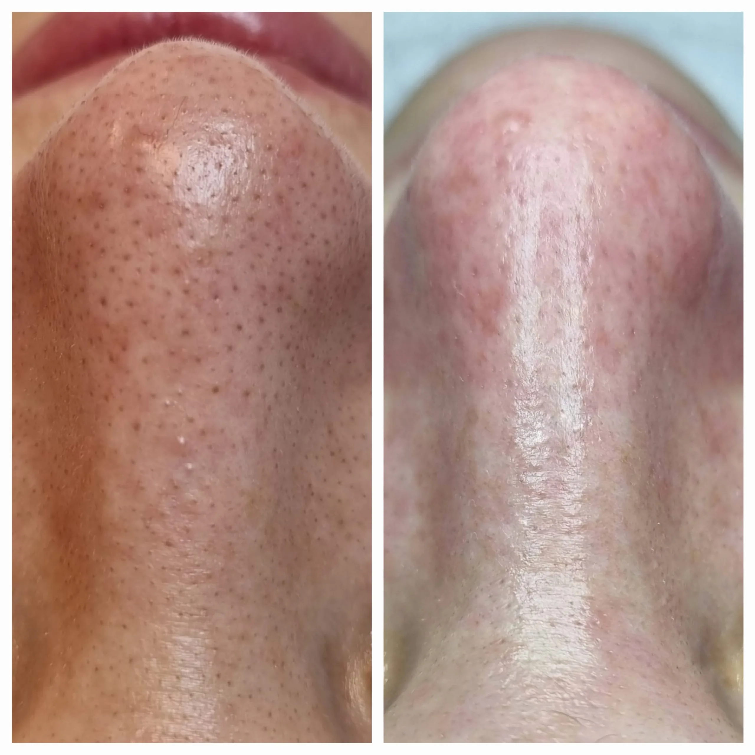 Tiefenreinigung des Gesichts – Larisa Cosmetic Winterthur
