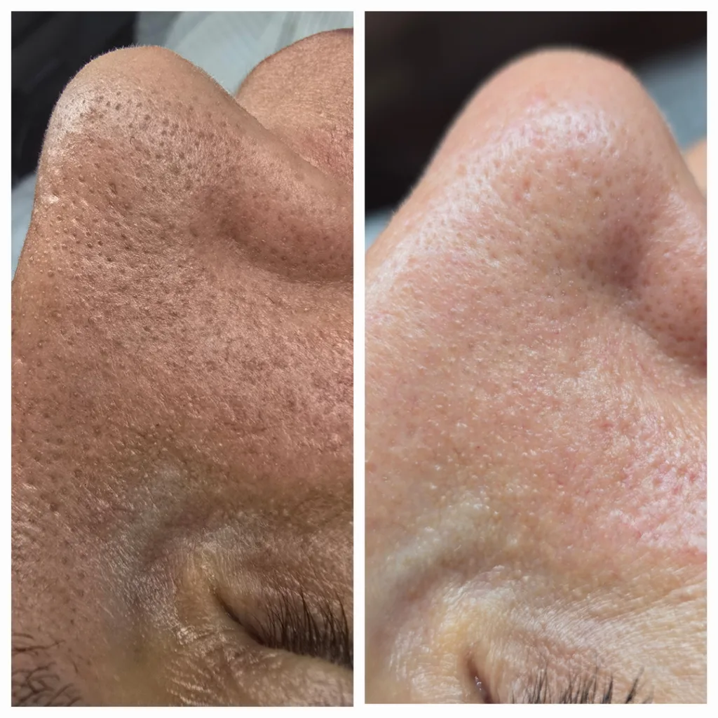 Wann braucht deine Haut eine professionelle Tiefenreinigung? 20250923 161451 1 1024x1024