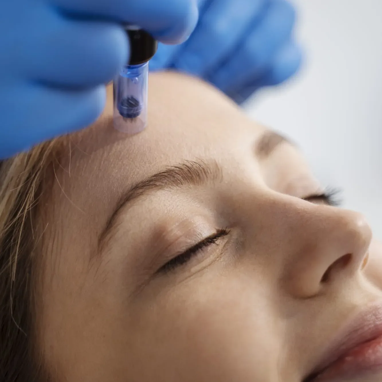 Microneedling Gesichtsbehandlung