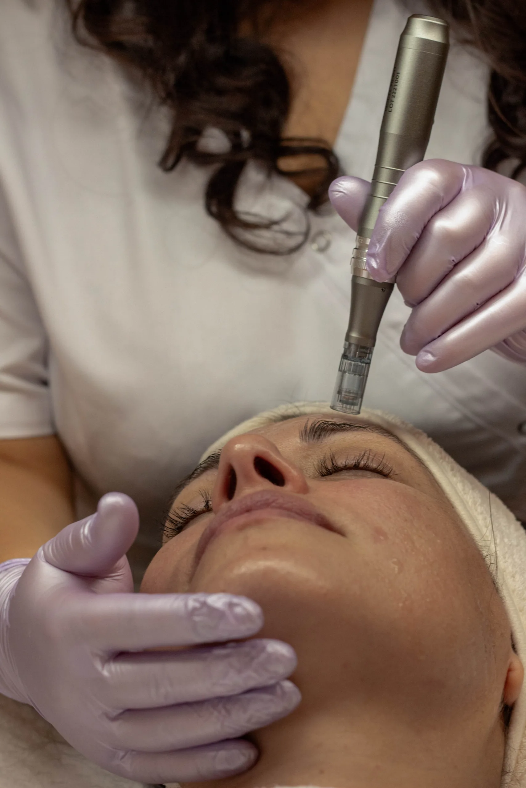 Microneedling Winterthur img 7038 (1)