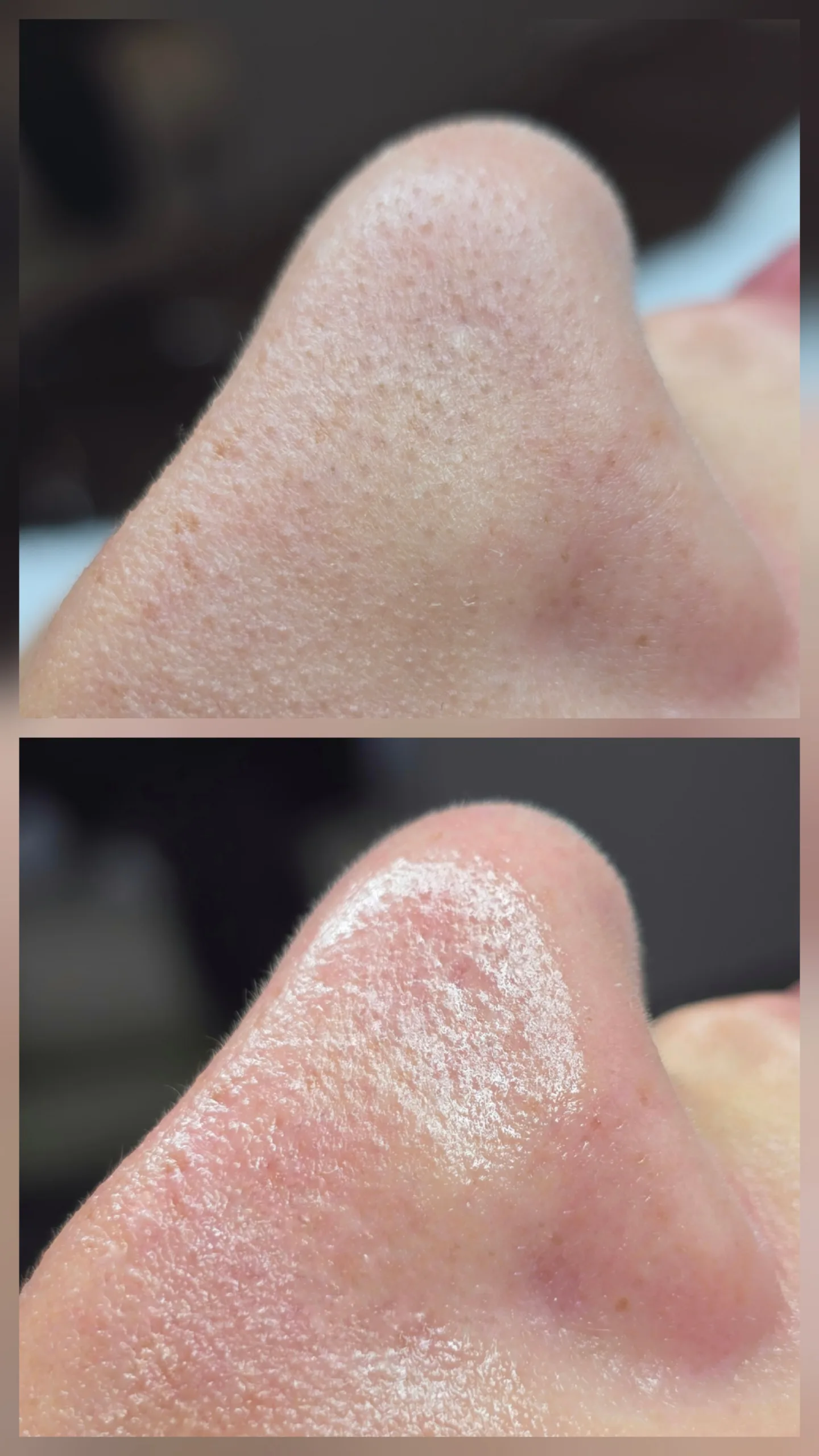 Tiefenreinigung Gesicht Resultat Larisa Cosmetic