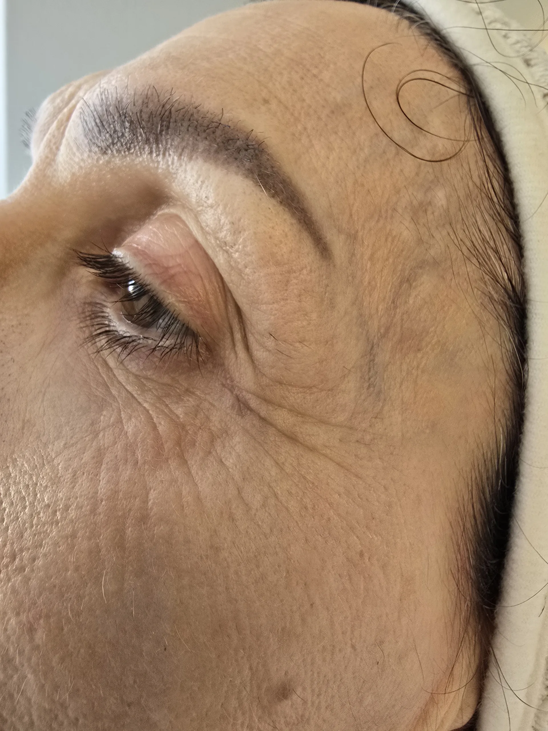 Vorher Gesichtsbehandlung Larisa Cosmetic