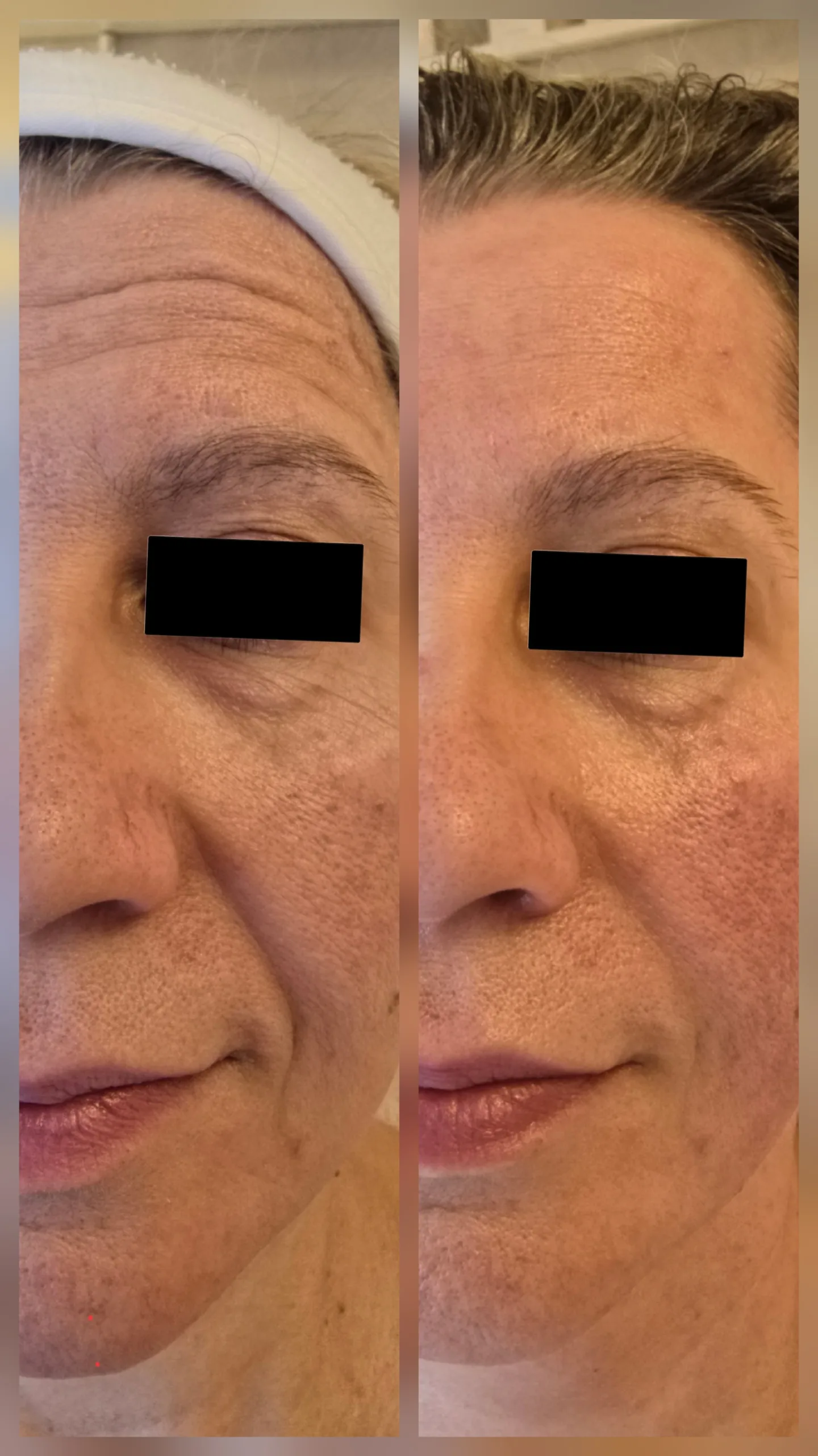 Kobido Behandlung bei Larisa Cosmetic
