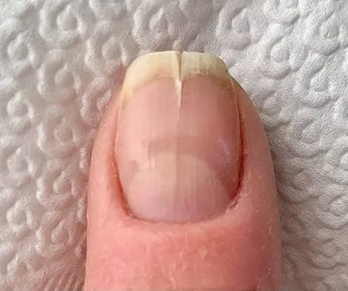 Vertikaler Nagelbruch