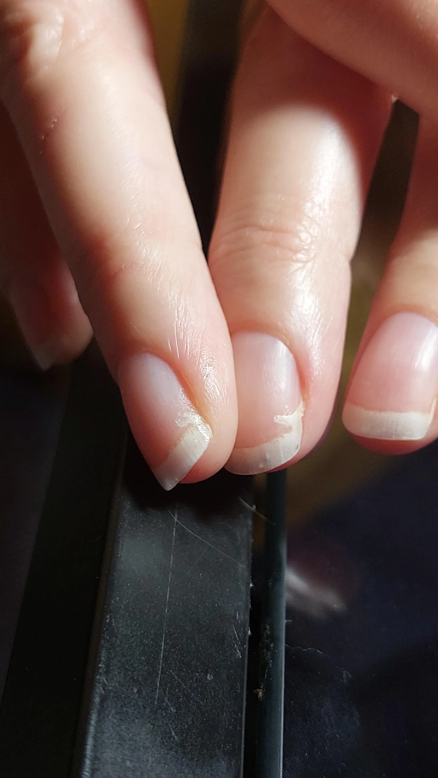 Horizontale Abblätterung des Nagels