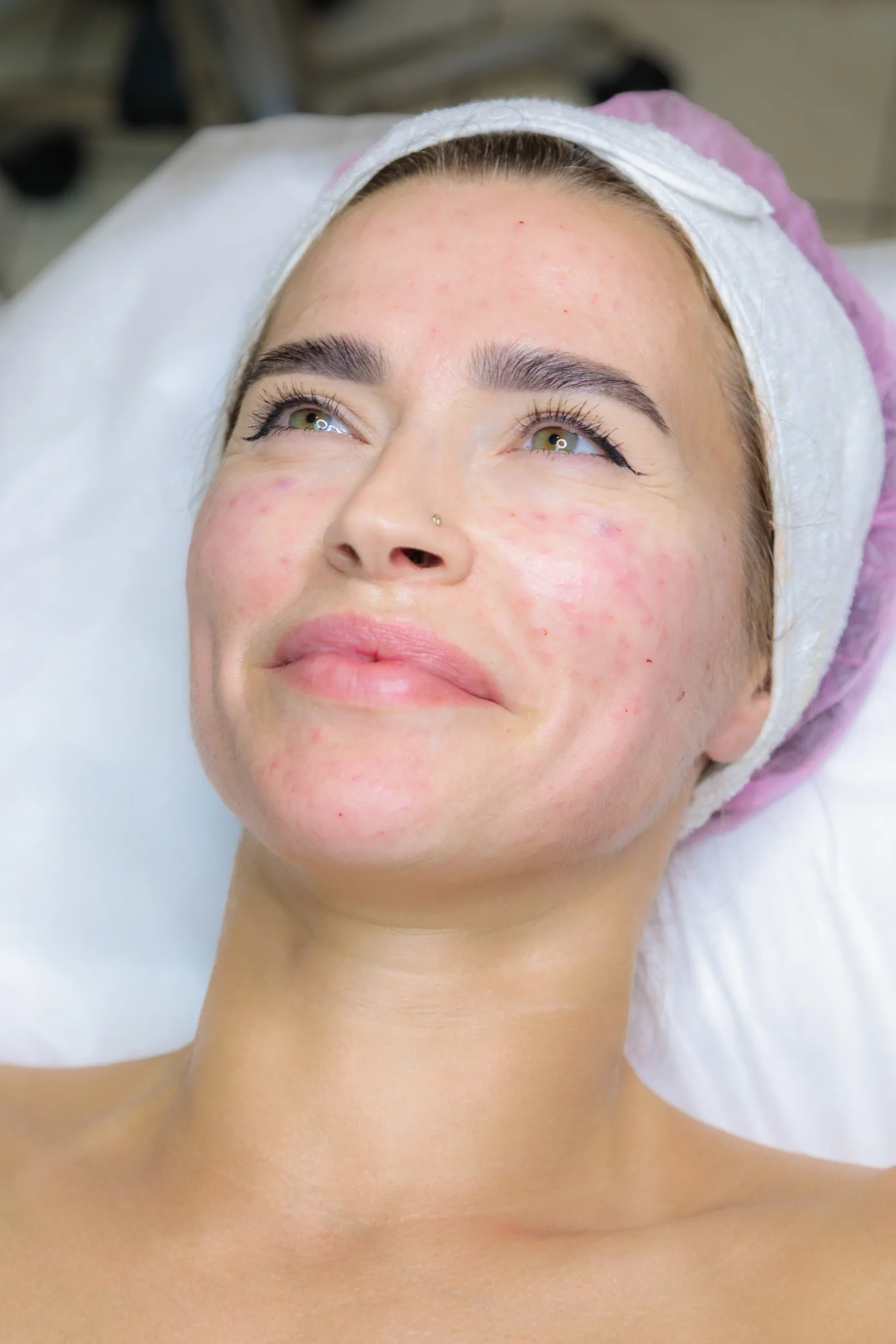 BioRePeel CL3 Biorevitalisierung Winterthur