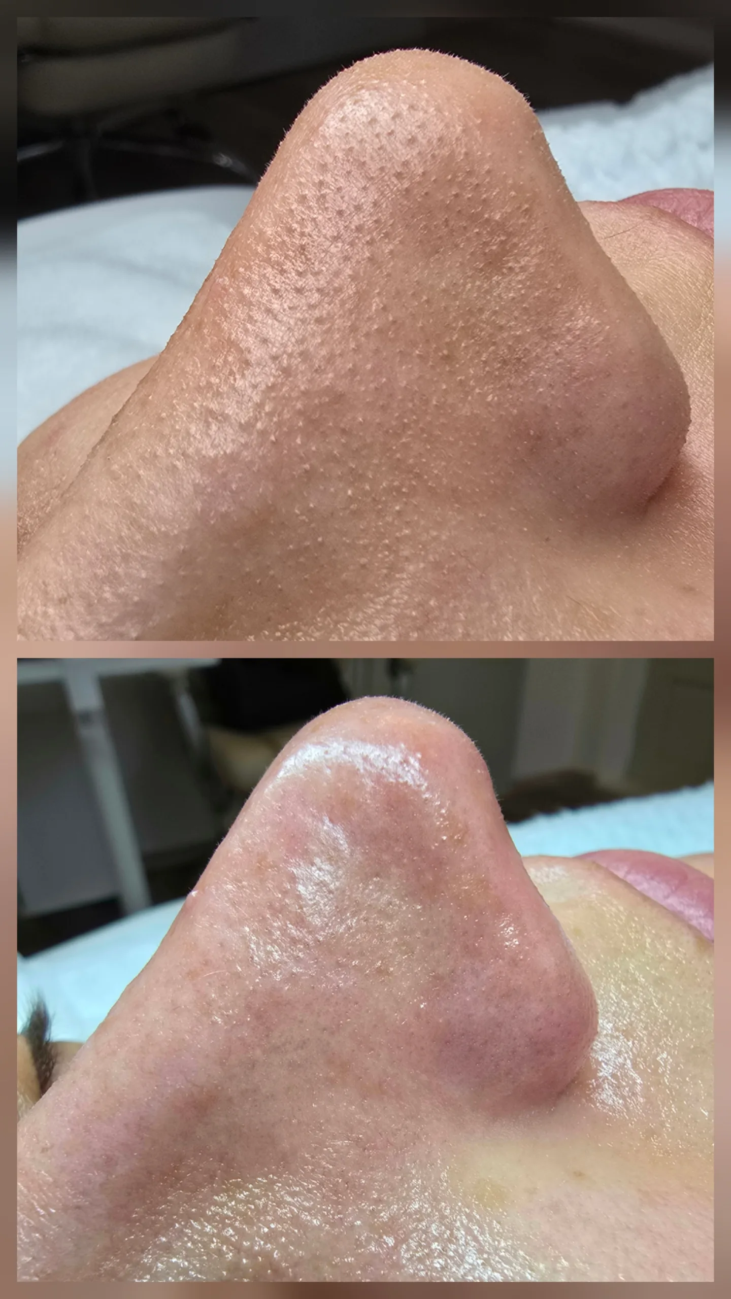 Ergebnis Tiefenreinigung Larisa Cosmetic Winterthur